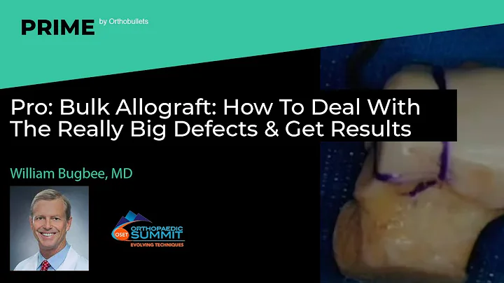 Pro: Bulk Allograft: How To Deal With The Really Big Defects & Get Results - William Bugbee, MD