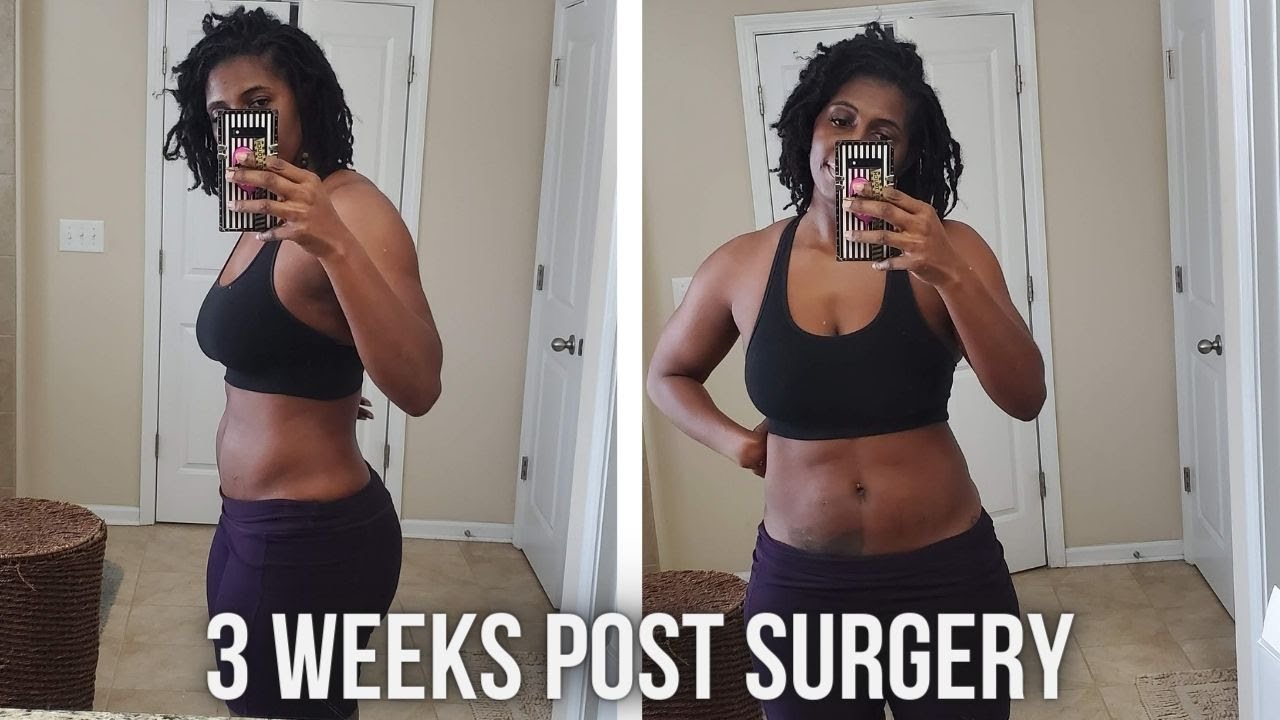 Did You Lose Weight After A Hysterectomy