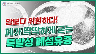 암보다 사망률이 높은 무서운 병! 폐가 딱딱해지는 폐섬유증의 모든 것 | 특발성 폐섬유증 ep.1