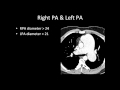 CT and MR Eval of RV Function and Pulmonary Hypertension