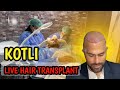 Live hair transplant done in kotli azad kashmir  first time in kashmir