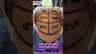 استمتع بشعر كثيف وجذاب مع زراعة الشعر الحديثة @HMC_Beauty