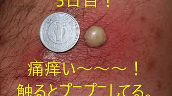 ニキビにゅるにゅる Youtube