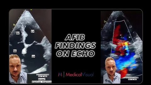 Echocardiography Findings in Atrial Fibrillation (Afib)