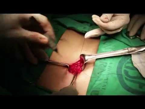 herniorrafia inguinal con malla