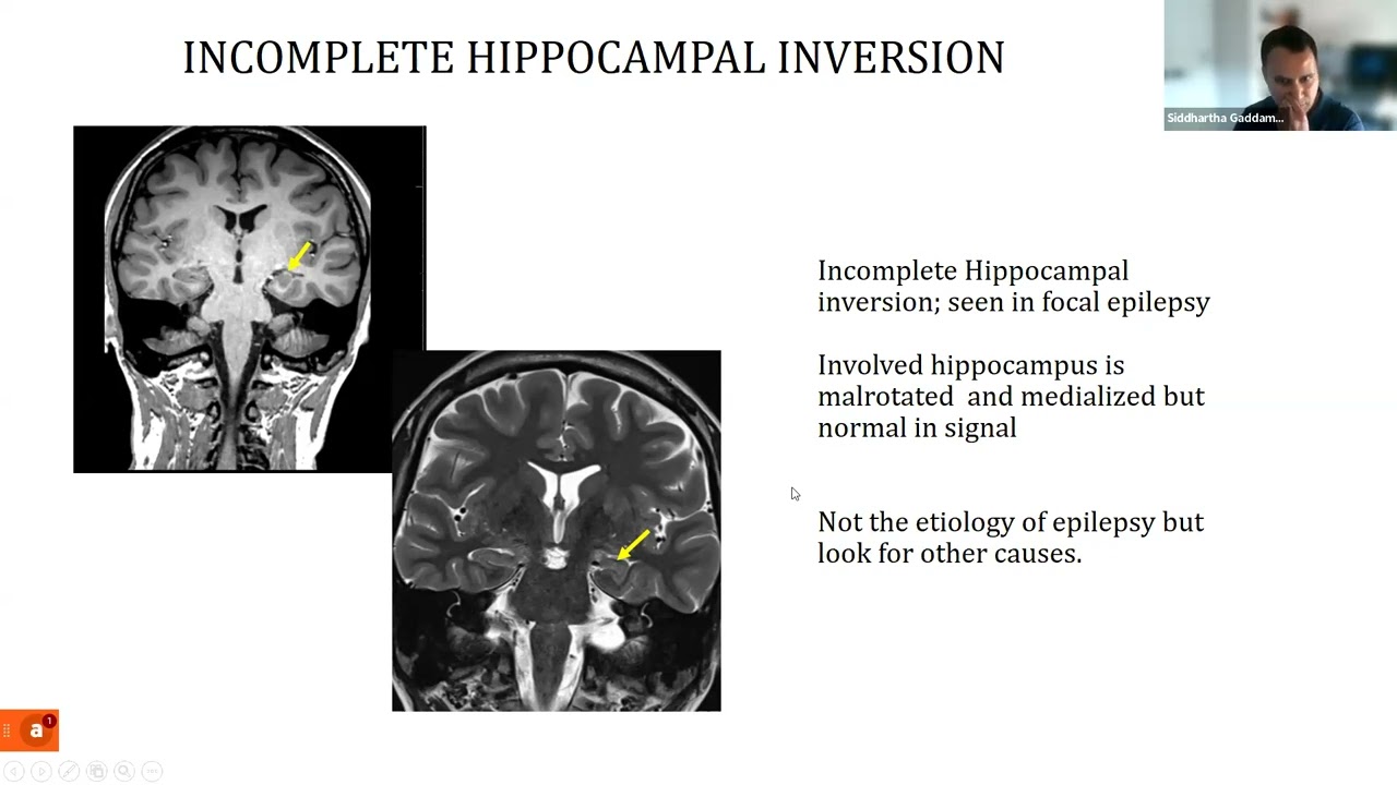 KREST WEBINARS: IMAGING TECHNIQUES IN EPILEPSY DIAGNOSIS, DR SIDDHARTHA.G , NEURORADIOLOGIST ,USA