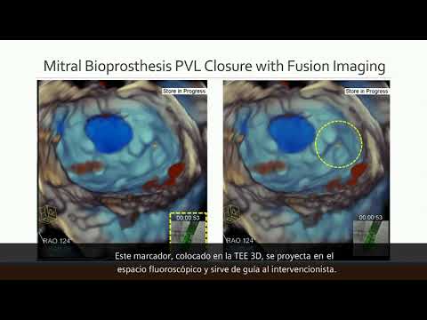 SOLACI-CACI 2021 | Deployment of Plug with TrueFusion