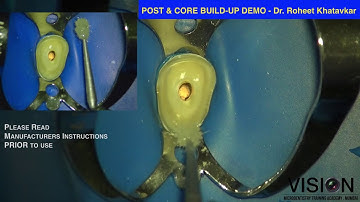 Post & Core build-up