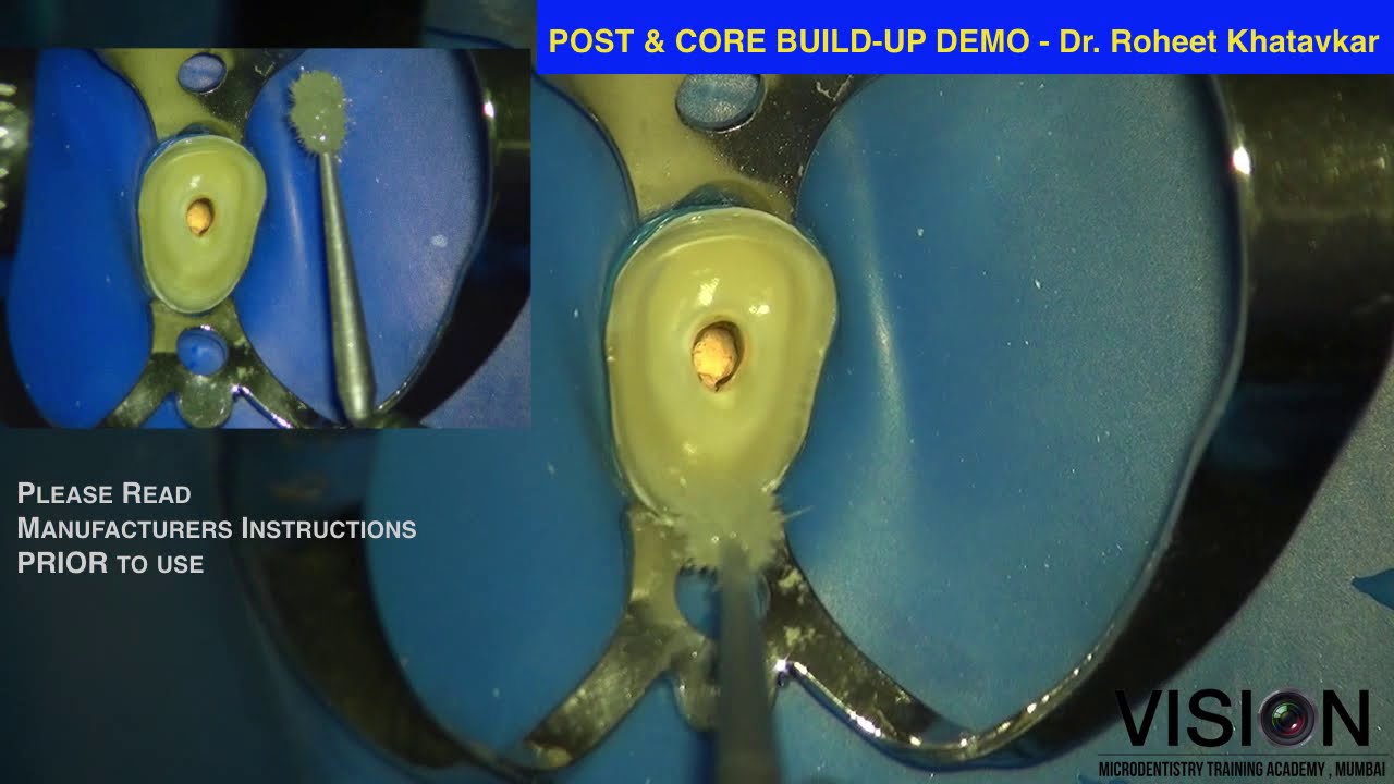 Post & Core buildup YouTube