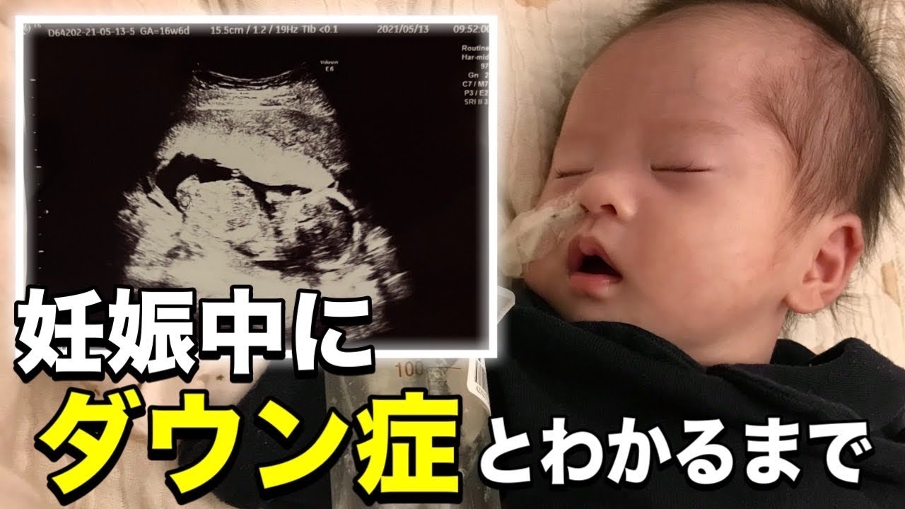 【告白】妊娠中にダウン症とわかるまでの本当の話