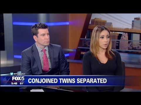 Conjoined Twins Separated (10-14-16)