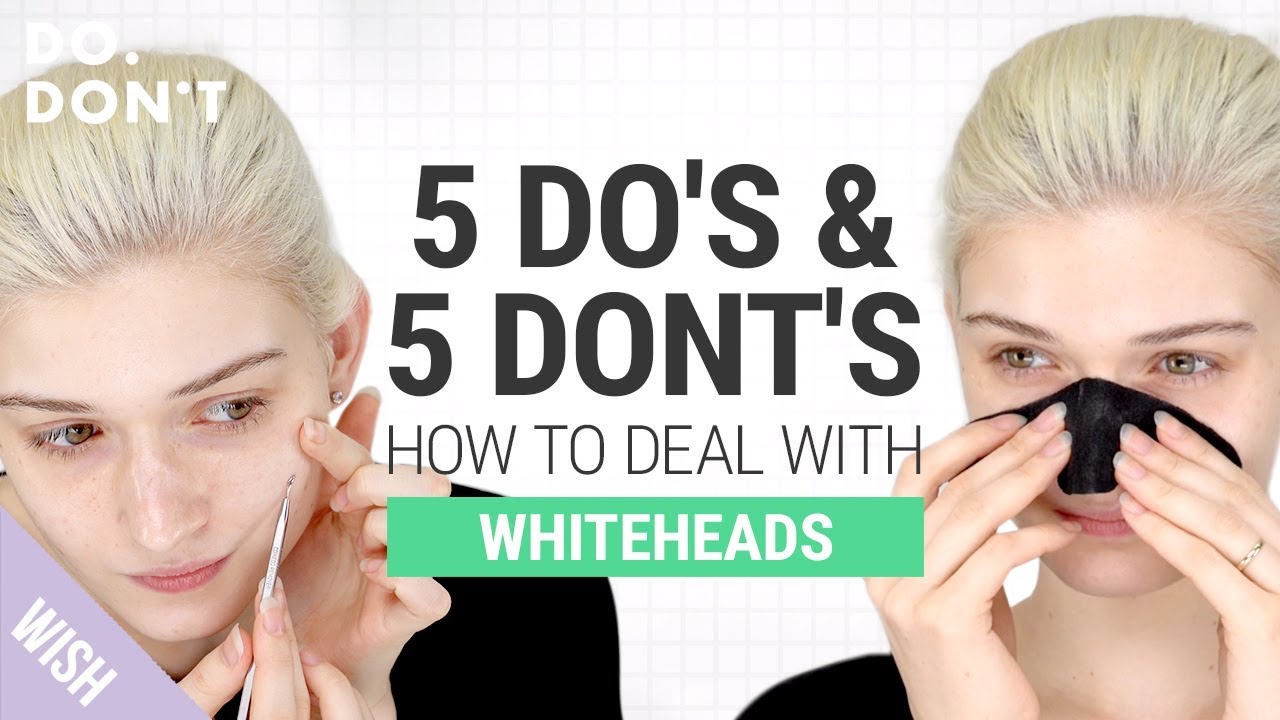 How To Get Rid Of Whiteheads On Face