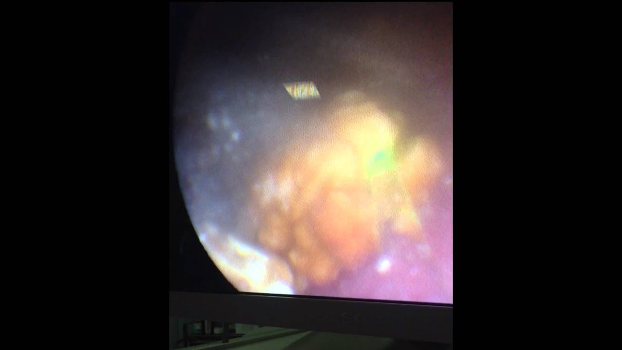 Kidney stone laser Lithotripsy YouTube