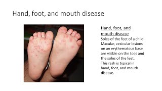 Hand, Foot and Mouth disease by House Job 19 views 1 month ago 3 minutes, 49 seconds