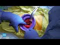 Total Hip Arthroplasty: Direct Anterior Approach on the HANA Table