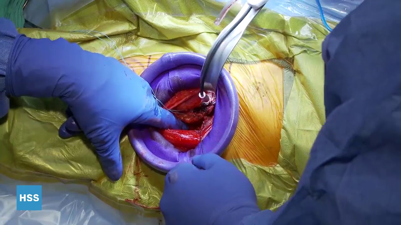 Total Hip Replacement Surgery Video