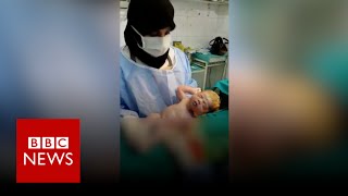 What it's like to perform a C-section in Aleppo - BBC News
