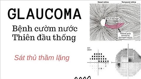 Bệnh Glôcôm (thiên đầu thống, cườm nước) nguy hiểm như thế nào? Nguyên nhân và cách điều trị!
