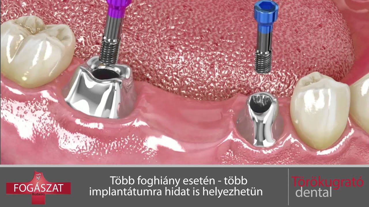 implantátumok a térdízületen