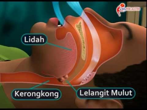 Video: Pembedahan Untuk Mendengkur: Pilihan, Keberkesanan, Dan Kos