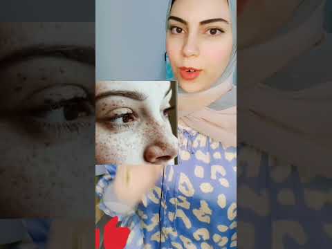 البهاق الخطوطو التعبيرية التجاعيد النمش  