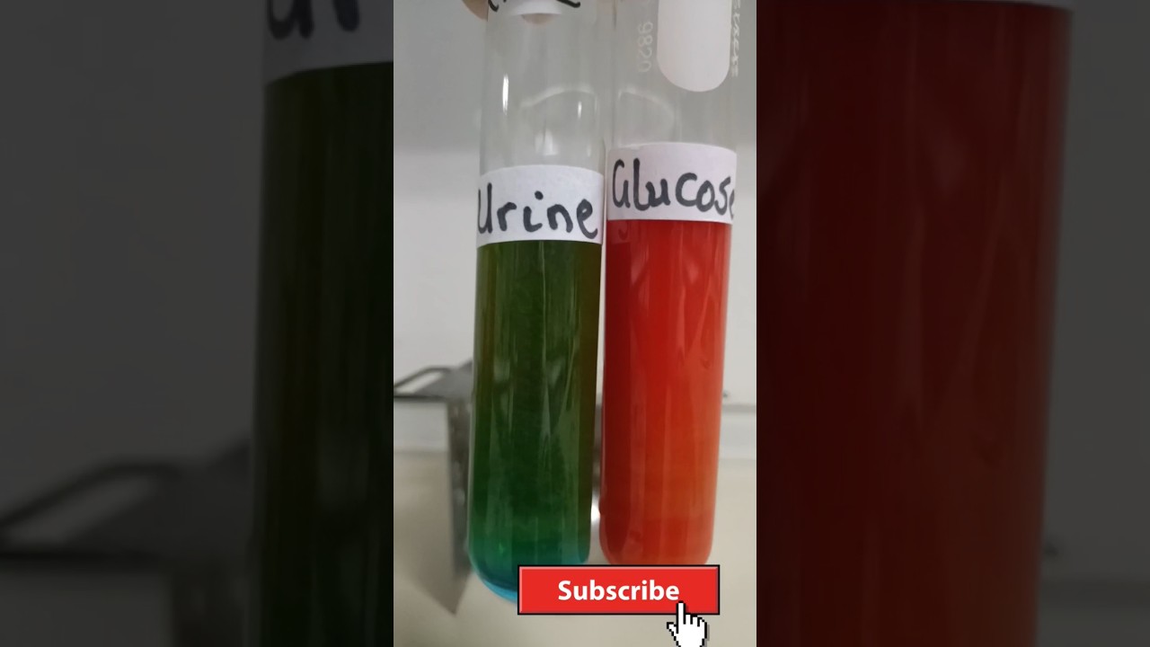 Benedict's Test For Reducing Sugars in Urine