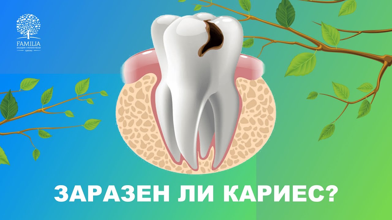 🙋 Заразен ли кариес?