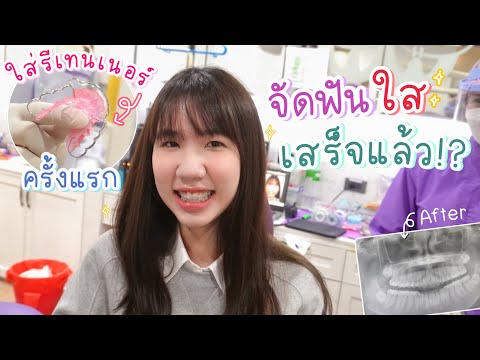 (cc) หน้าเปลี่ยนไป!? ใส่รีเทนเนอร์แบบเหล็กครั้งแรก วิธีดูแล นนนี่จัดฟันใส Invisalign เสร็จแล้ว Nonny