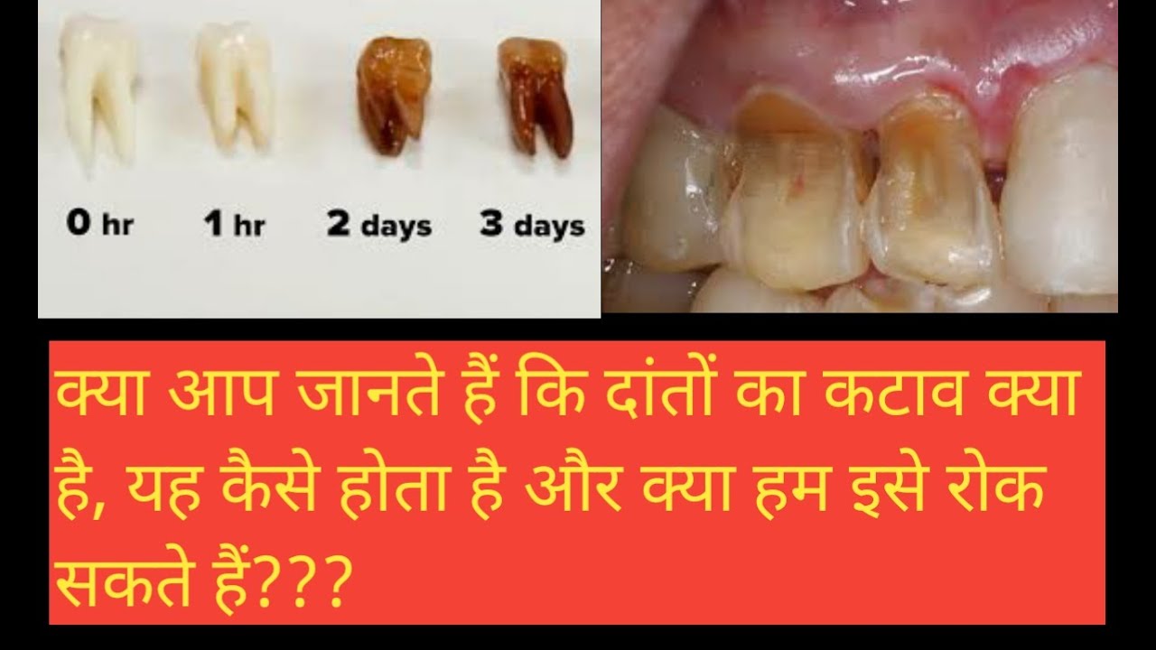 let's know about what is EROSION OF TOOTH ? YouTube