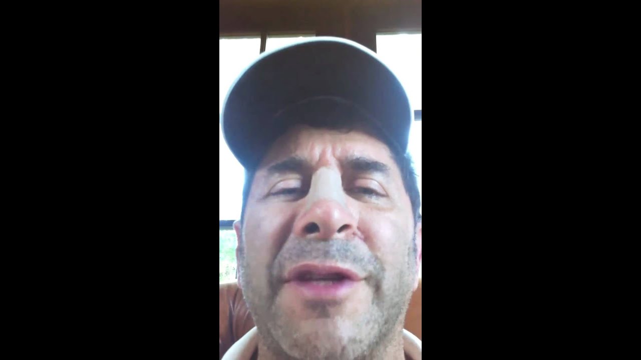 Dr. Nassif Day 10 Recovery Rhinoplasty Journal YouTube