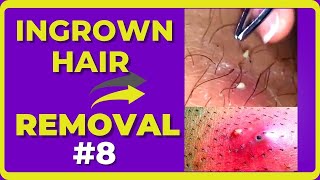 Ingrown Hair [Compilations Videos #8] #RemovalHair #HairRemoval #내성발톱  #ingrownhairShorts