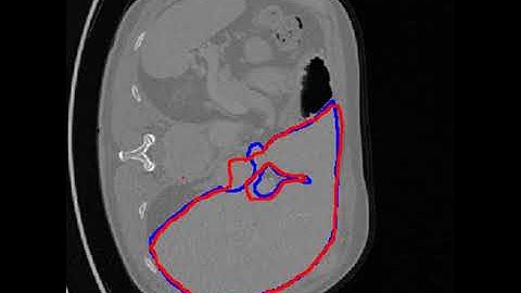 Liver and liver tumor segmentation and detection
