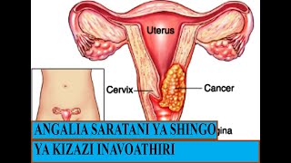 ANGALIA SARATANI YA SHINGO YA KIZAZI INAVYOATHIRI