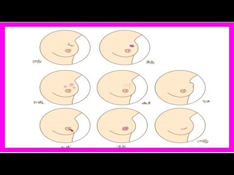 乳腺癌有哪些前兆？