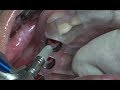 Hydraulic sinus elevation  implantation with dentium digital guide drhyunki roh