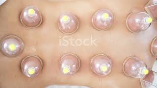 Hijama / Wet Cupping Therapy. Unlock the Secrets to Natural Healing!