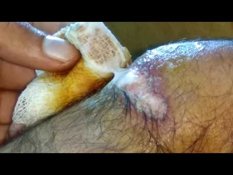 how to remove bandage from wound(without pain)