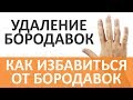 Бородавки удаление. Бородавки на руках. Бородавки на ногах. Бородавки на лице