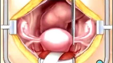 Hysterectomy Removal of the Uterus Surgery - PreOp® Patient Education