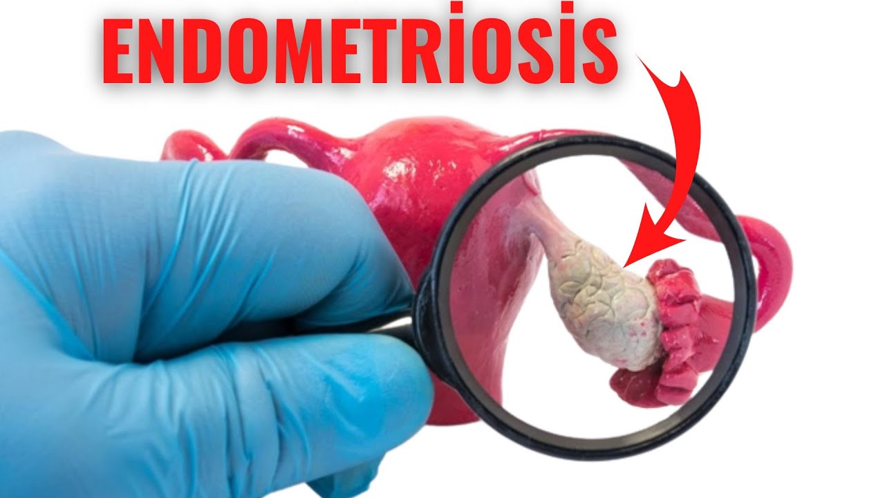 Endometriosis YouTube