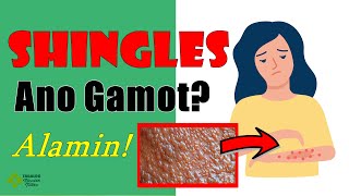 Ano GAMOT sa SHINGLES? Tagalog Health Tips | Nurse Dianne