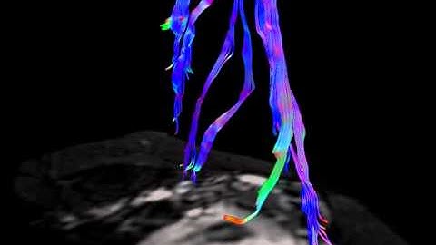 Fiber tractography