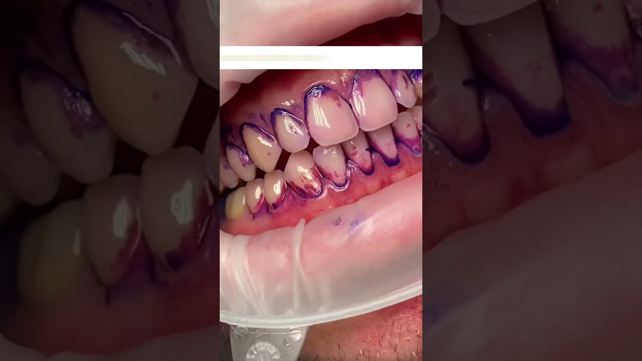 Airflow hygienist - Wisdom dental Leigh on sea 