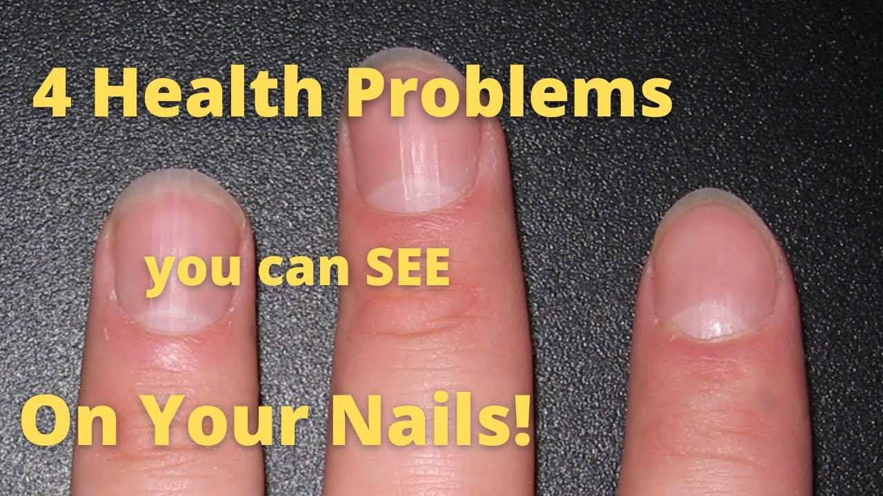 4 Health Problems You Can SEE On Your Nails