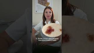 Чтобы не пропустить рак кожи... #дерматология #дерматолог
