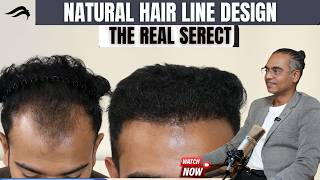 Hair Transplant In Chennai | Best Clinic Results Surgeon & Cost Of Hair Transplant In Chennai