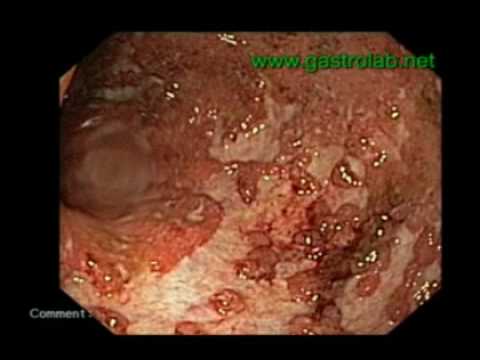 A Fulminant Ulcerative Colitis
