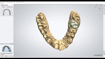 Form 3B - Removable Die Models in 3Shape Dental System
