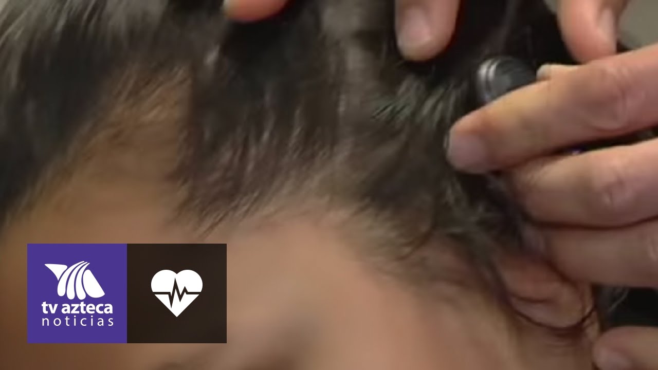 seguridad alimentaria ¿Qué es y a quiénes afecta la hipoacusia?