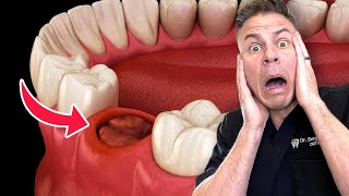 Is This Wisdom Teeth Removal Myth Busted?!